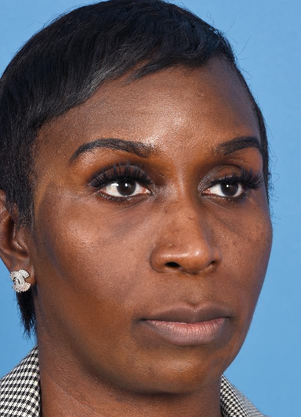Post photo of woman getting botox