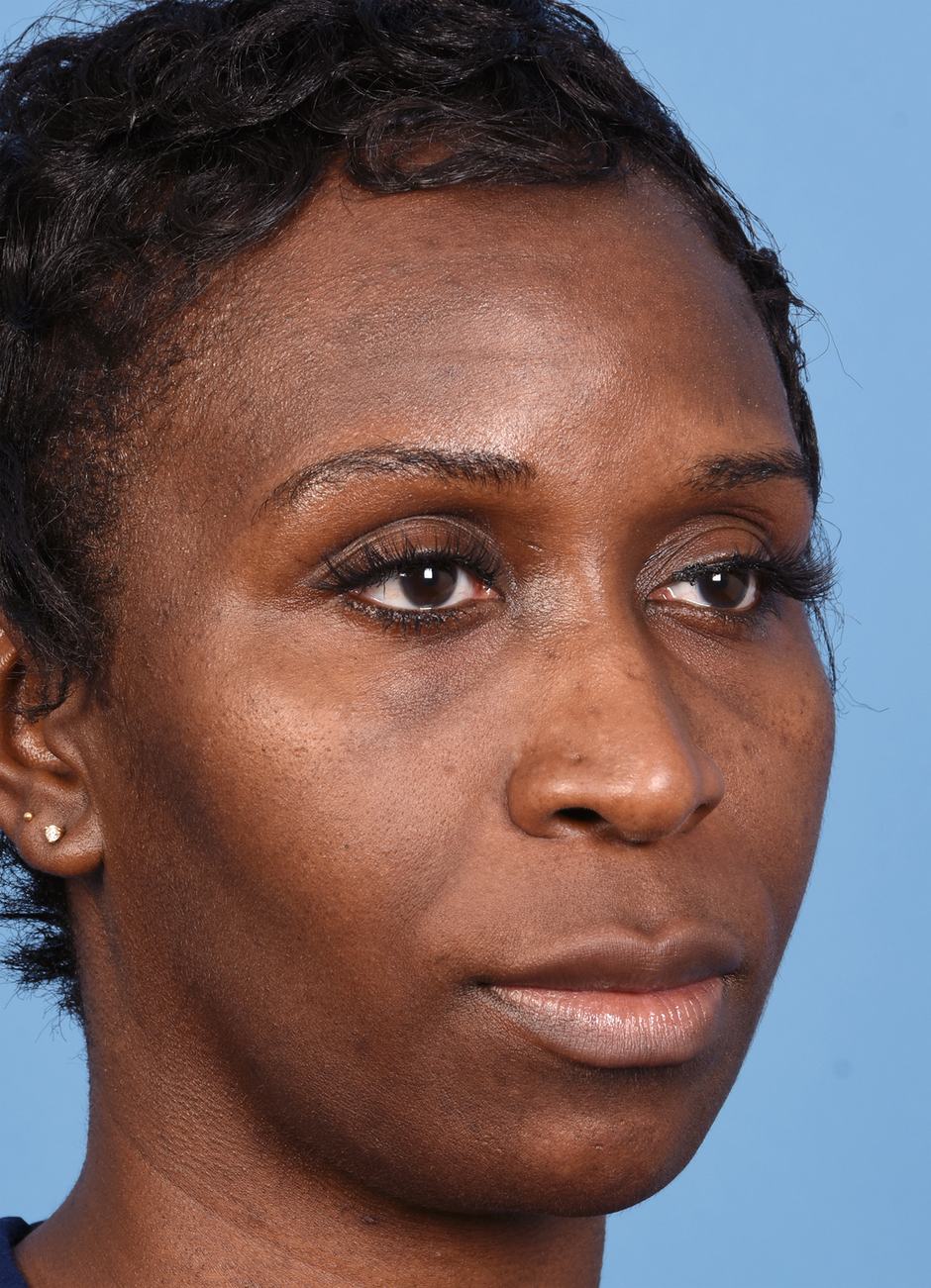 Pre photo of woman getting botox