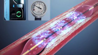 Intravascular lithotripsy: Using sonic waves to break up plaque in heart arteries