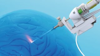 Laser surgery offers hope for patients living with epilepsy and brain cancer