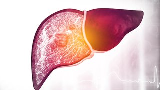 Taking aim at fatty liver, cancer with new blood test