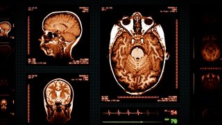 Using magnets to treat major depressive disorder: Clinical trial shows promise