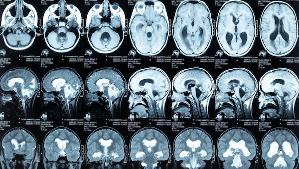 NPH: A misunderstood form of dementia that can be reversed