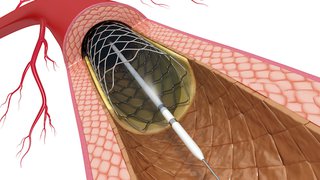 How PCI stenting can reduce chest pain and heart attack damage – without surgery