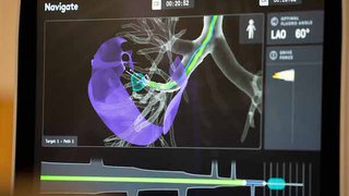 Robotic bronchoscopy offers minimally invasive, earlier lung cancer diagnosis