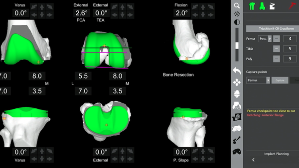 Robotic knee replacement surgery enhances precision, personalization