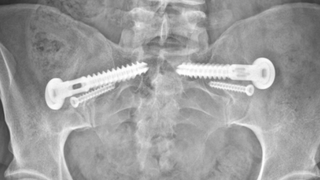 New keyhole sacroiliac joint fusion procedure relieves lower-back pain