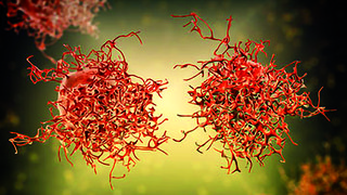 A New SPORE for Liver Cancer