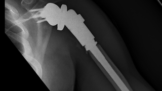 Advances in sarcoma surgery help preserve life and limbs