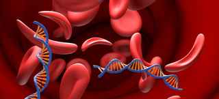 The image shows a microscopic view of blood cells, with some appearing as normal, round shapes, while others are misshapen and crescent-like, characteristic of sickle cell disease.