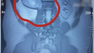 UTSW removes runner’s melon-sized spine tumor with minimally invasive surgery