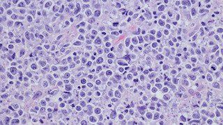 Dedicated Clinic for Lymphoma Cancer Treatments