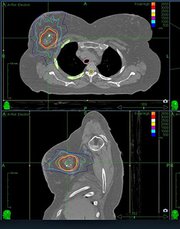 5 questions patients might be reluctant to ask about radiation therapy ...