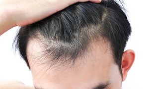 PRP for hair loss: Can it reverse baldness without surgery, pills, or creams?