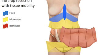 Tailoring the dress or suit: The benefits of skin removal surgery after major weight loss