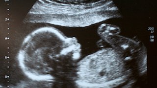 Helping you understand scary (but often harmless) pregnancy ultrasound findings