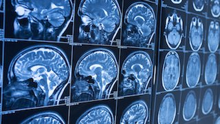 Who should consider epilepsy surgery, and when