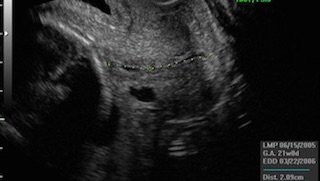 Should I have a transvaginal ultrasound to measure cervical length and help prevent preterm delivery?