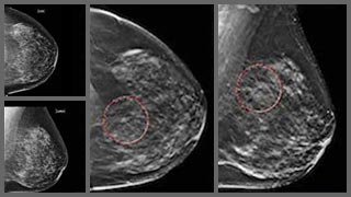 A big step for breast health in Texas: 3-D mammograms now covered by insurance