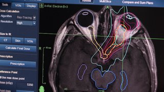 Treating brain tumors with stereotactic radiosurgery
