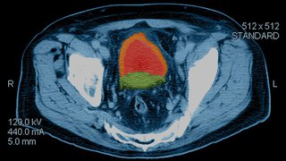 New Breakthroughs in Prostate Cancer Treatment - Featured image