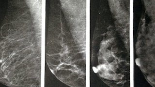 Different tests for different breasts