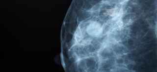 Breast Imaging | Conditions & Treatments | UT Southwestern