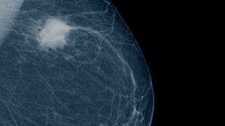 Enhancing Immunotherapy Drug Trials for Patients with Breast Cancer - Featured image