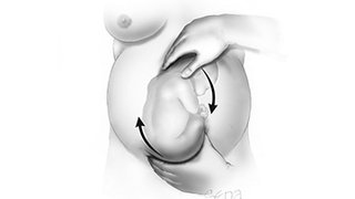 Can you turn a breech baby around?