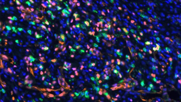 AXL Inhibition Restores Response to PD-1 Blockade in STK11/LKB1-mutant NSCLC