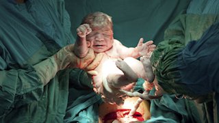 Why you should ask about your hospital’s C-section rate