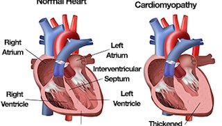 Hypertrophic cardiomyopathy affects young and old