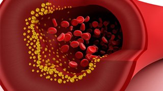 New cholesterol-lowering drugs show promising results in trials