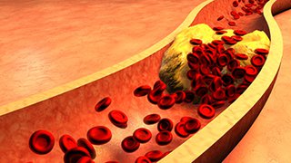 New drugs approved for lowering cholesterol – and the story has roots at UT Southwestern