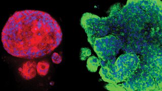 Clarifying the Mechanics of Brain Metastasis in Breast Cancer