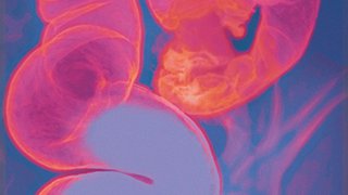 Incubating Progress: PROSPR/Colon Cancer
