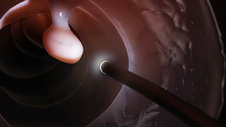 8 common myths about colon cancer