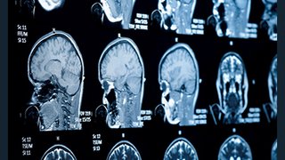 Why are concussions different for veterans?