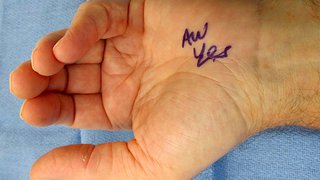 Restoring hand function impaired by Dupuytren’s contracture
