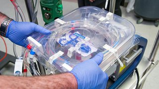 Portable ECMO Machine Adds Another Option to Lung Transplant Program Portfolio