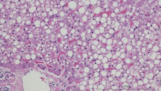 What is fatty liver disease, and what are we doing to treat it?