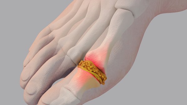 Gout: A modern resurgence of an ancient disease