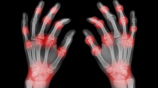 Get a handle on arthritis pain with specialized wrist and hand treatments