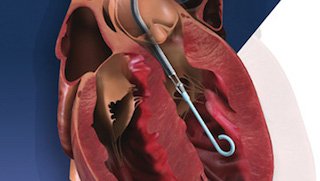 Mini heart pump makes high-risk stenting safer