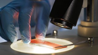 New, lifechanging hemophilia treatments improve patients’ health, outlook