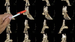 High ankle sprain vs. low ankle sprain: What are the key differences?