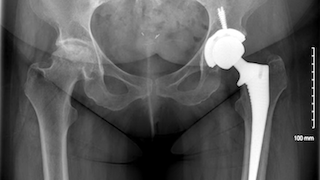 Tracking hip surgery variables