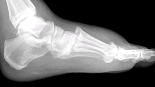 What is a Lisfranc injury and how come it sidelines athletes for so long?
