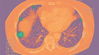 Metastatic Lung Cancer