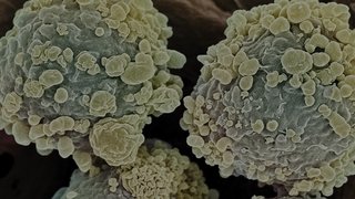 Why Cancer Care Specialization Matters: The Story of Chronic Lymphocytic Leukemia Survivor William Marks